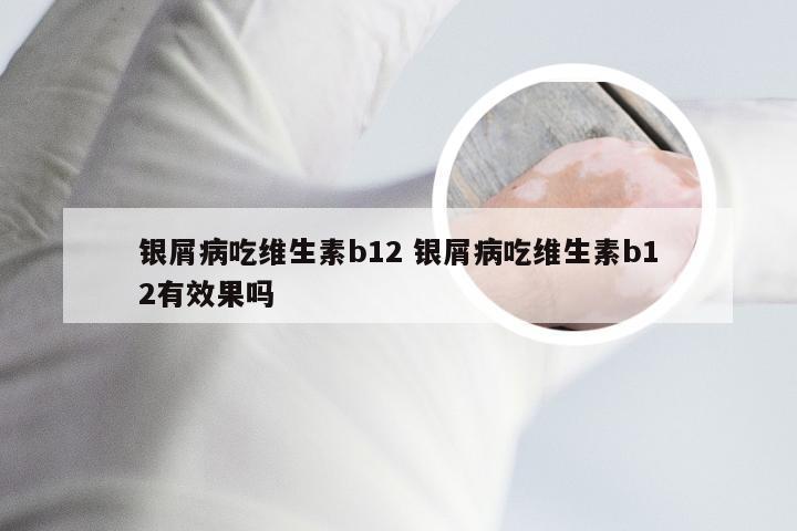 银屑病吃维生素b12 银屑病吃维生素b12有效果吗