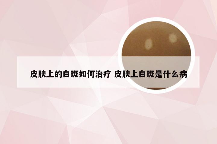 皮肤上的白斑如何治疗 皮肤上白斑是什么病