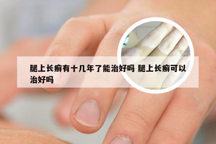 腿上长癣有十几年了能治好吗 腿上长癣可以治好吗