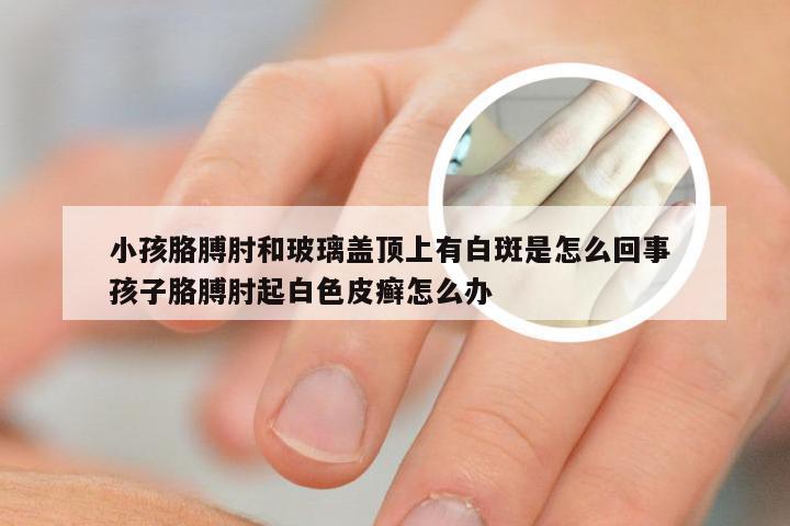 小孩胳膊肘和玻璃盖顶上有白斑是怎么回事 孩子胳膊肘起白色皮癣怎么办