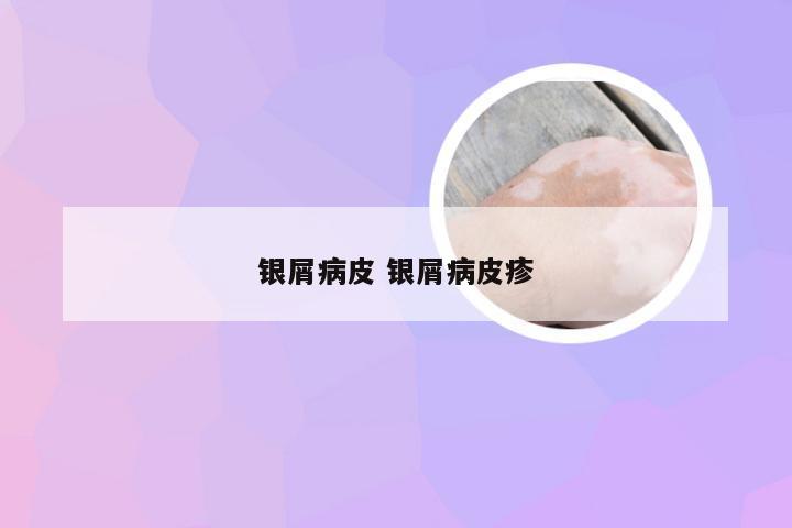 银屑病皮 银屑病皮疹