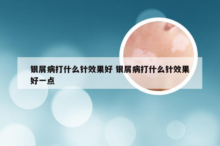 银屑病打什么针效果好 银屑病打什么针效果好一点