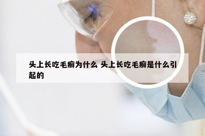 头上长吃毛癣为什么 头上长吃毛癣是什么引起的