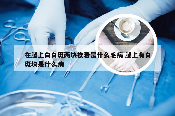 在腿上白白斑两块挨着是什么毛病 腿上有白斑块是什么病