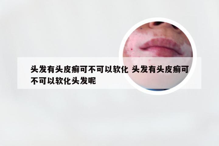 头发有头皮癣可不可以软化 头发有头皮癣可不可以软化头发呢