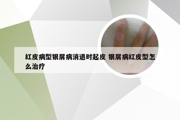 红皮病型银屑病消退时起皮 银屑病红皮型怎么治疗