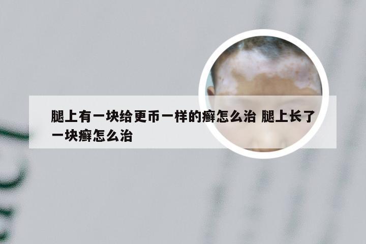 腿上有一块给更币一样的癣怎么治 腿上长了一块癣怎么治