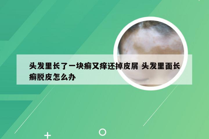 头发里长了一块癣又痒还掉皮屑 头发里面长癣脱皮怎么办