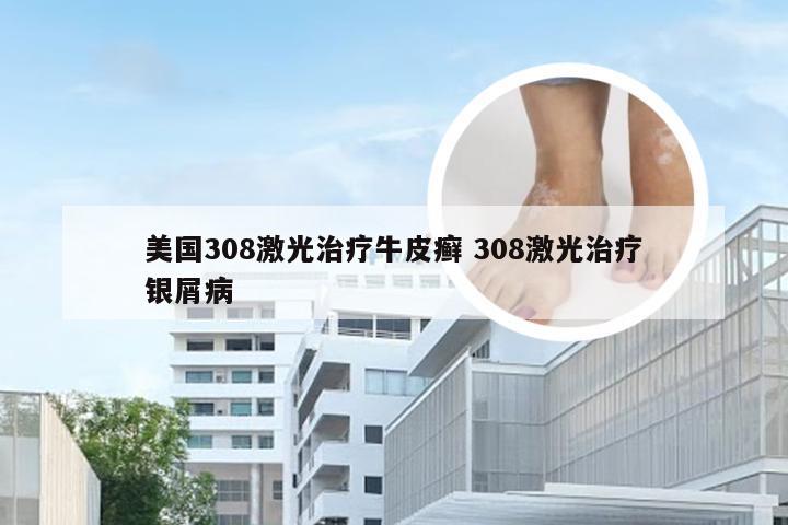 美国308激光治疗牛皮癣 308激光治疗银屑病