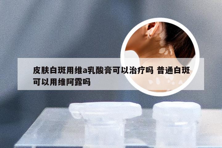 皮肤白斑用维a乳酸膏可以治疗吗 普通白斑可以用维阿露吗