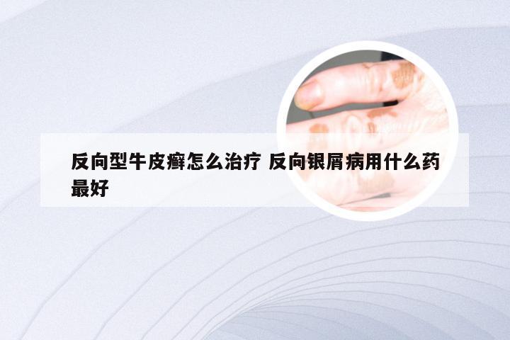 反向型牛皮癣怎么治疗 反向银屑病用什么药最好