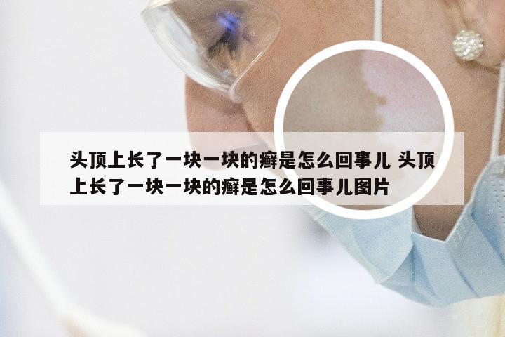 头顶上长了一块一块的癣是怎么回事儿 头顶上长了一块一块的癣是怎么回事儿图片