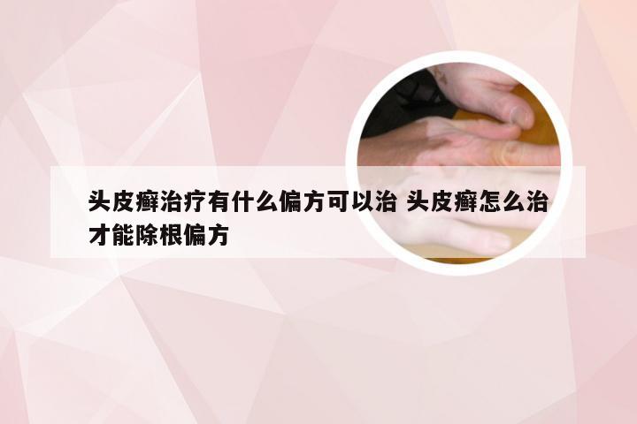 头皮癣治疗有什么偏方可以治 头皮癣怎么治才能除根偏方