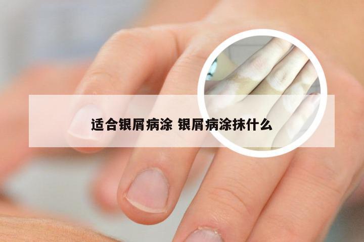 适合银屑病涂 银屑病涂抹什么