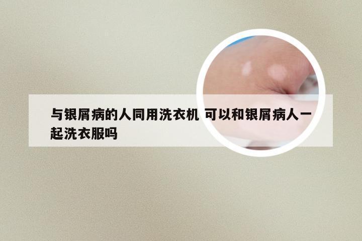 与银屑病的人同用洗衣机 可以和银屑病人一起洗衣服吗