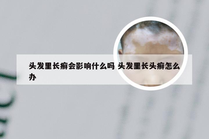 头发里长癣会影响什么吗 头发里长头癣怎么办