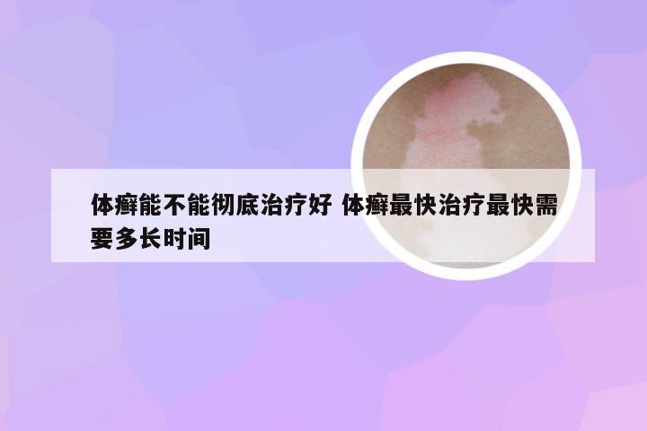 体癣能不能彻底治疗好 体癣最快治疗最快需要多长时间