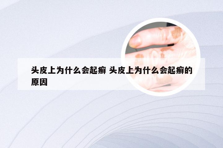 头皮上为什么会起癣 头皮上为什么会起癣的原因