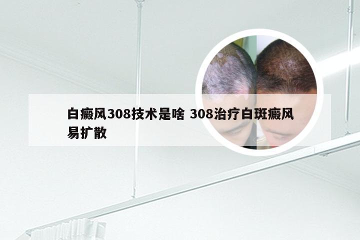 白癜风308技术是啥 308治疗白斑癜风易扩散