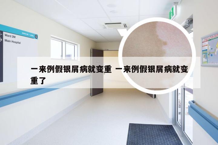 一来例假银屑病就变重 一来例假银屑病就变重了