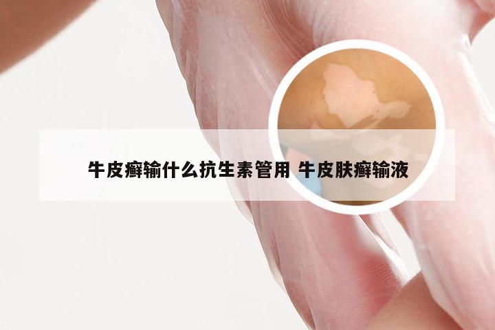 牛皮癣输什么抗生素管用 牛皮肤癣输液