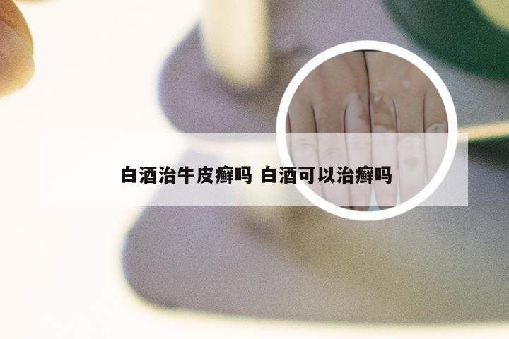 白酒治牛皮癣吗 白酒可以治癣吗