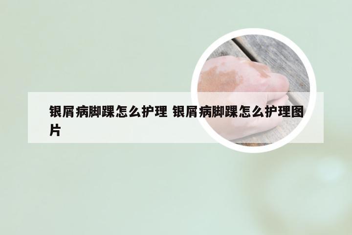 银屑病脚踝怎么护理 银屑病脚踝怎么护理图片