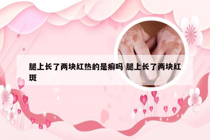 腿上长了两块红热的是癣吗 腿上长了两块红斑