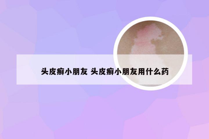 头皮癣小朋友 头皮癣小朋友用什么药