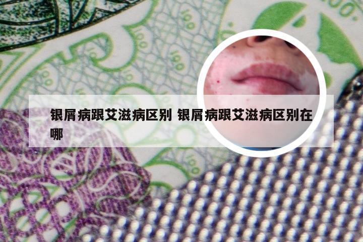 银屑病跟艾滋病区别 银屑病跟艾滋病区别在哪