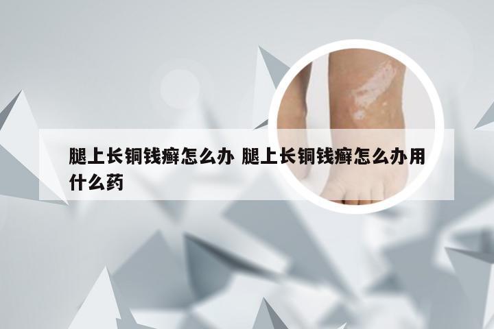 腿上长铜钱癣怎么办 腿上长铜钱癣怎么办用什么药