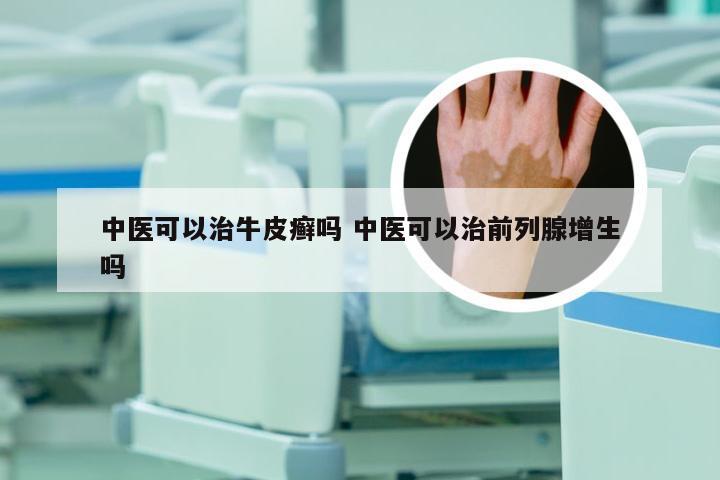 中医可以治牛皮癣吗 中医可以治前列腺增生吗