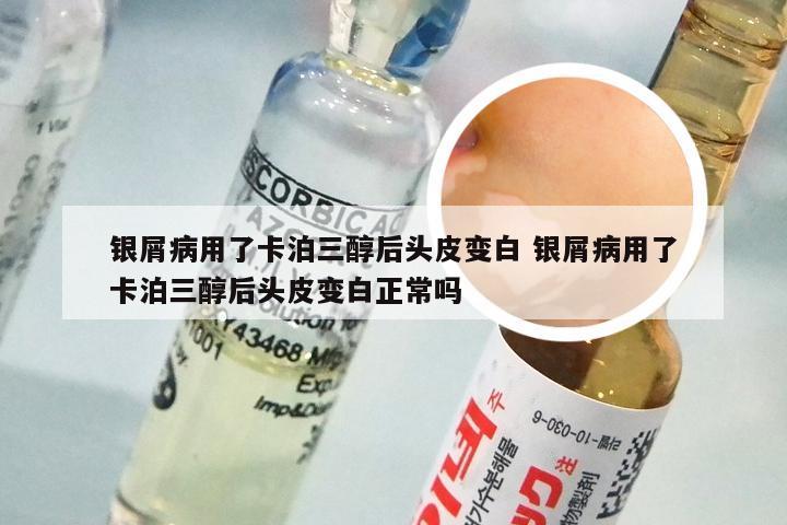 银屑病用了卡泊三醇后头皮变白 银屑病用了卡泊三醇后头皮变白正常吗