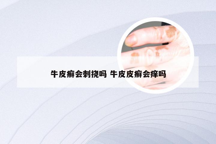 牛皮癣会刺挠吗 牛皮皮癣会痒吗