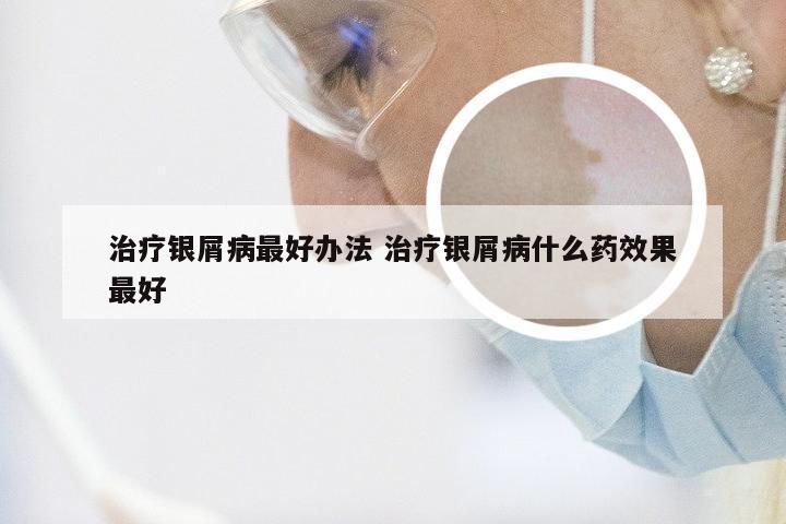 治疗银屑病最好办法 治疗银屑病什么药效果最好