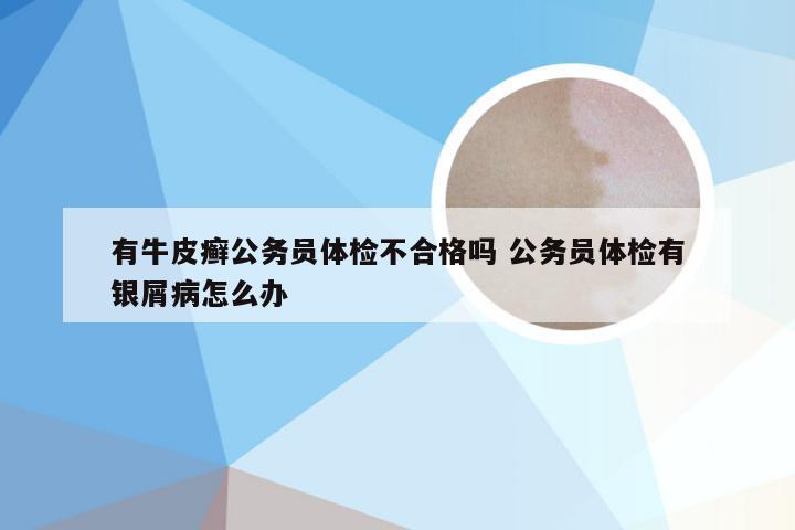 有牛皮癣公务员体检不合格吗 公务员体检有银屑病怎么办