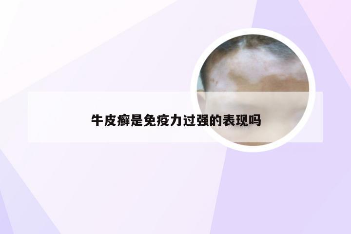 牛皮癣是免疫力过强的表现吗