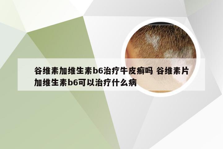 谷维素加维生素b6治疗牛皮癣吗 谷维素片加维生素b6可以治疗什么病