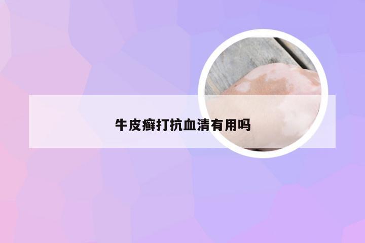 牛皮癣打抗血清有用吗