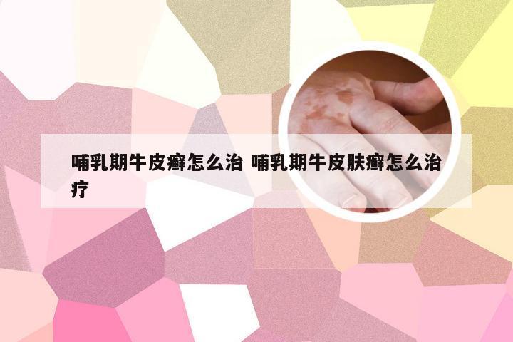 哺乳期牛皮癣怎么治 哺乳期牛皮肤癣怎么治疗