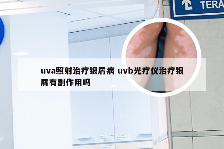 uva照射治疗银屑病 uvb光疗仪治疗银屑有副作用吗