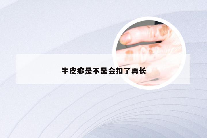 牛皮癣是不是会扣了再长