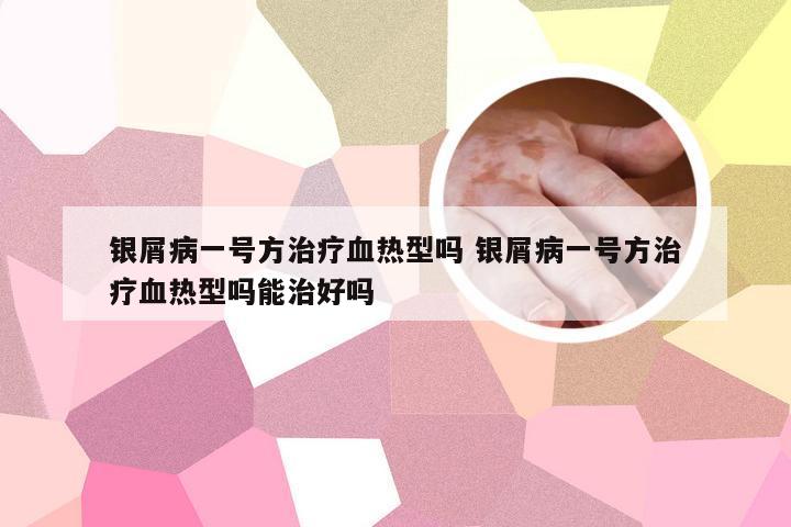 银屑病一号方治疗血热型吗 银屑病一号方治疗血热型吗能治好吗