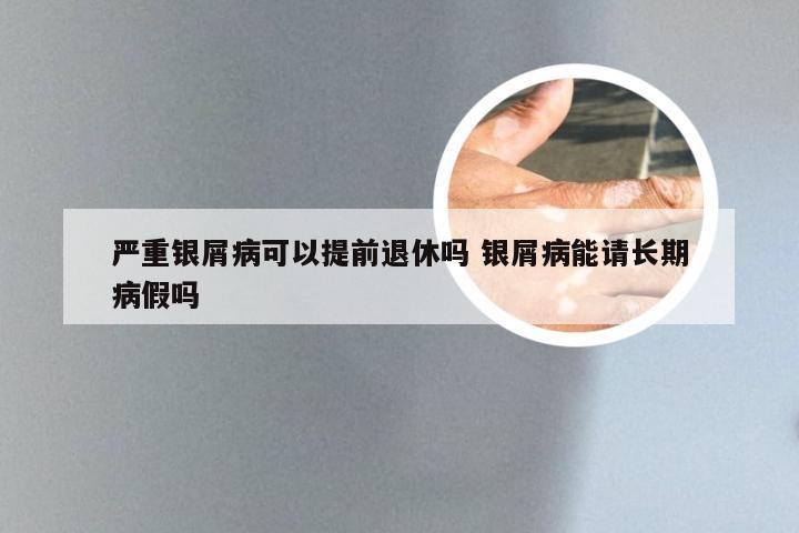 严重银屑病可以提前退休吗 银屑病能请长期病假吗