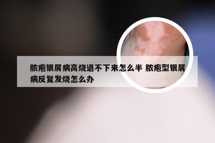 脓疱银屑病高烧退不下来怎么半 脓疱型银屑病反复发烧怎么办