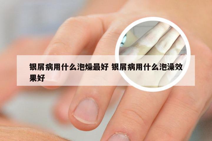 银屑病用什么泡燥最好 银屑病用什么泡澡效果好