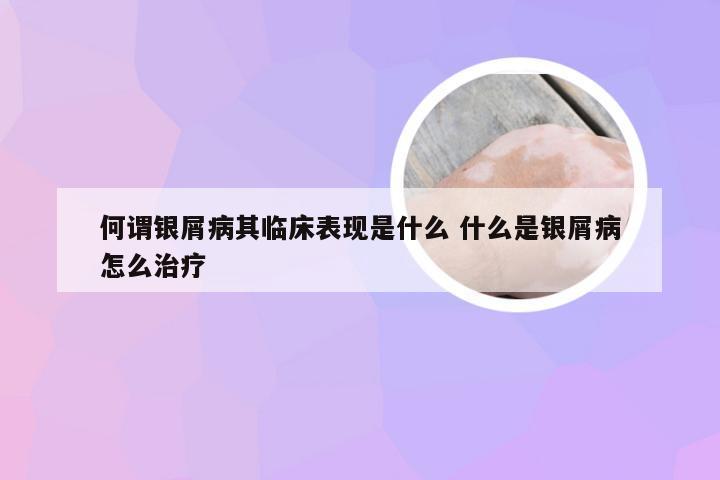 何谓银屑病其临床表现是什么 什么是银屑病怎么治疗