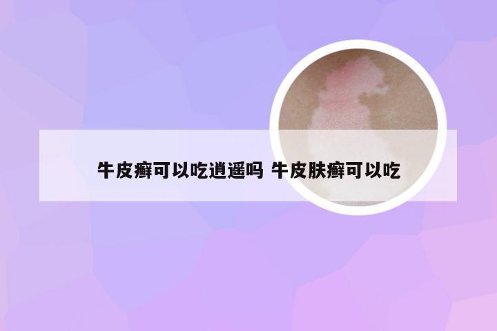 牛皮癣可以吃逍遥吗 牛皮肤癣可以吃