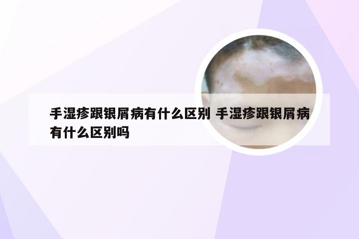 手湿疹跟银屑病有什么区别 手湿疹跟银屑病有什么区别吗