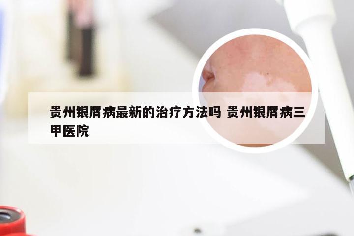 贵州银屑病最新的治疗方法吗 贵州银屑病三甲医院